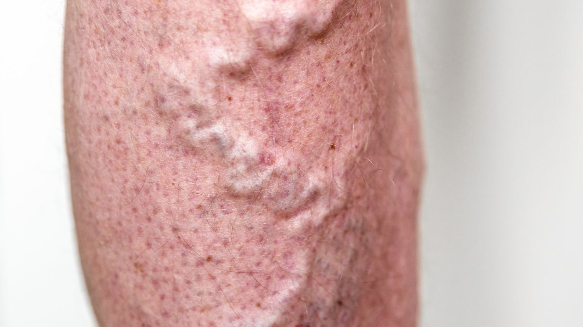 Is it normal to have veins on Penis